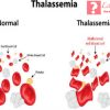 Thalassemia là bệnh gì – Có phòng tránh được nó không