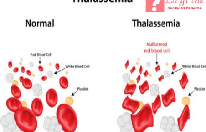 Thalassemia là bệnh gì – Có phòng tránh được nó không